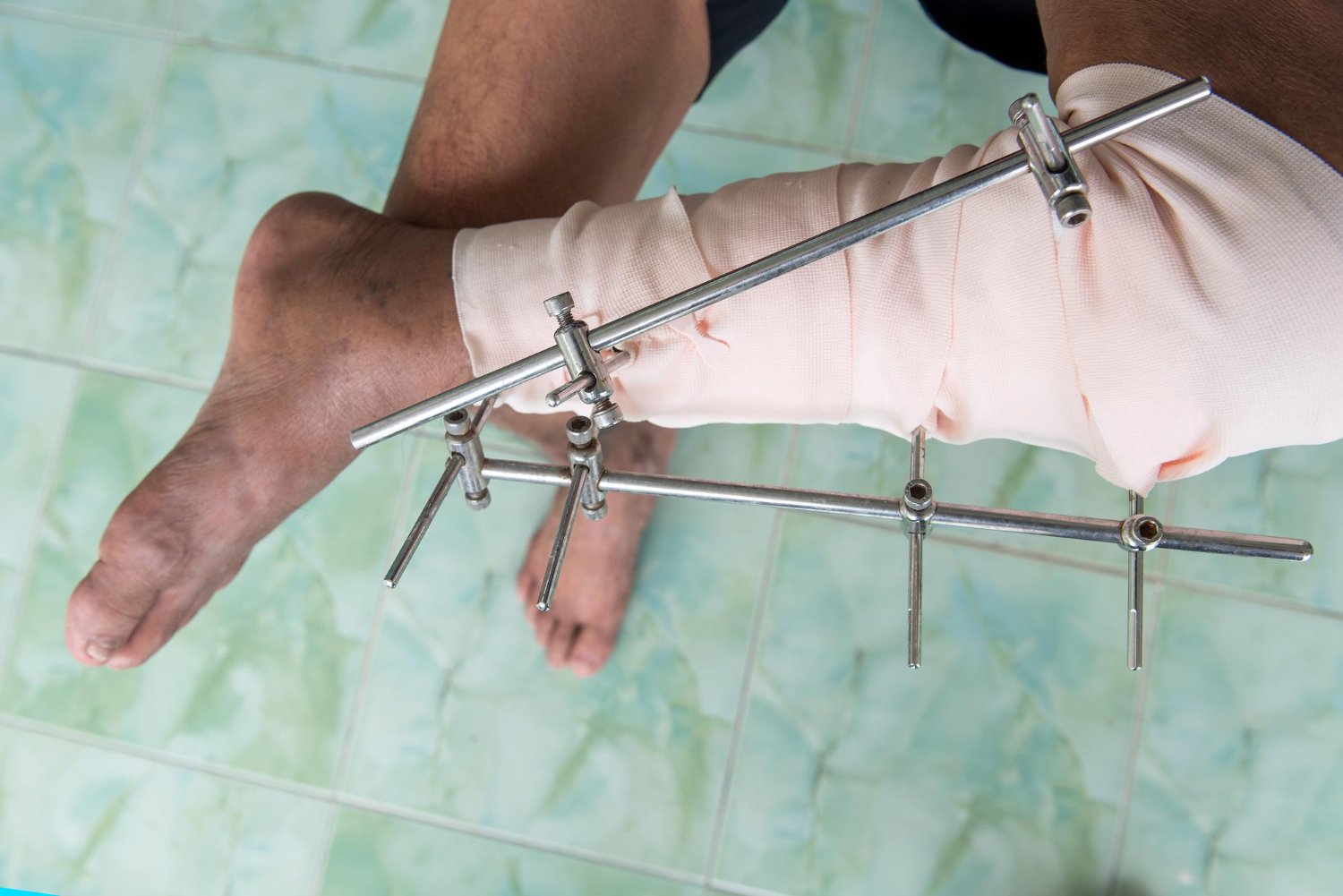 Knock Knee & Bowleg Deformity Correction